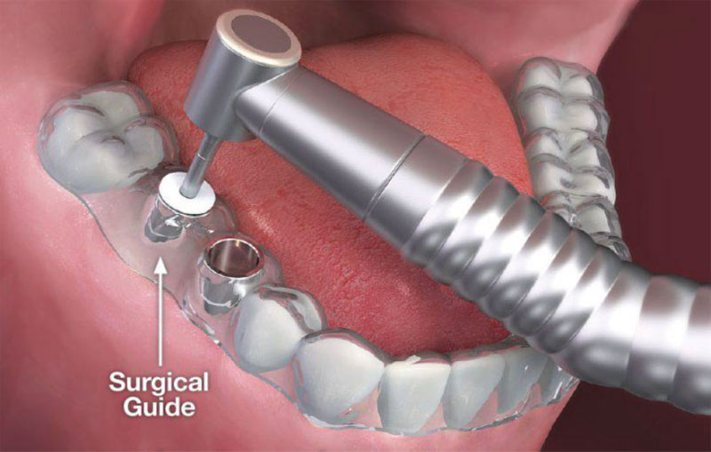 Guided Implant Surgery | Dent Blanche Dental