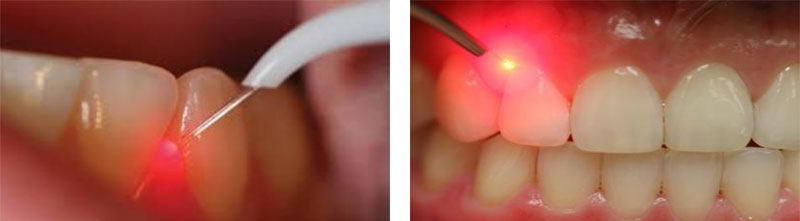 Laser Dental Procedures | Premier Dental Arts